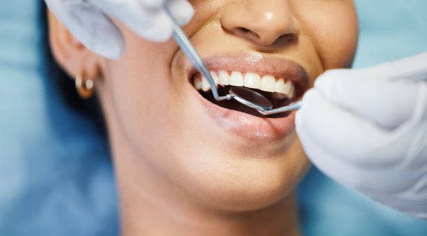 Best Knocked-Out Tooth (Avulsed Tooth) Treatment in Denmark, SC